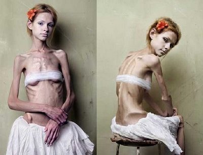 http://www.whatcauses.net/wp-content/uploads/2009/10/anorexia-nervosa.jpg